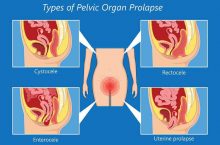 Menstrual Cups & Prolapse
